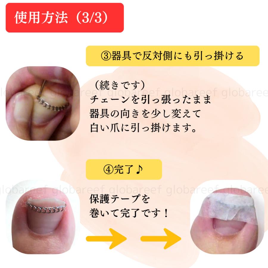 巻き爪 矯正 陥入爪 ケア 調整 セルフケア 数量限定 特別価格 チェーン