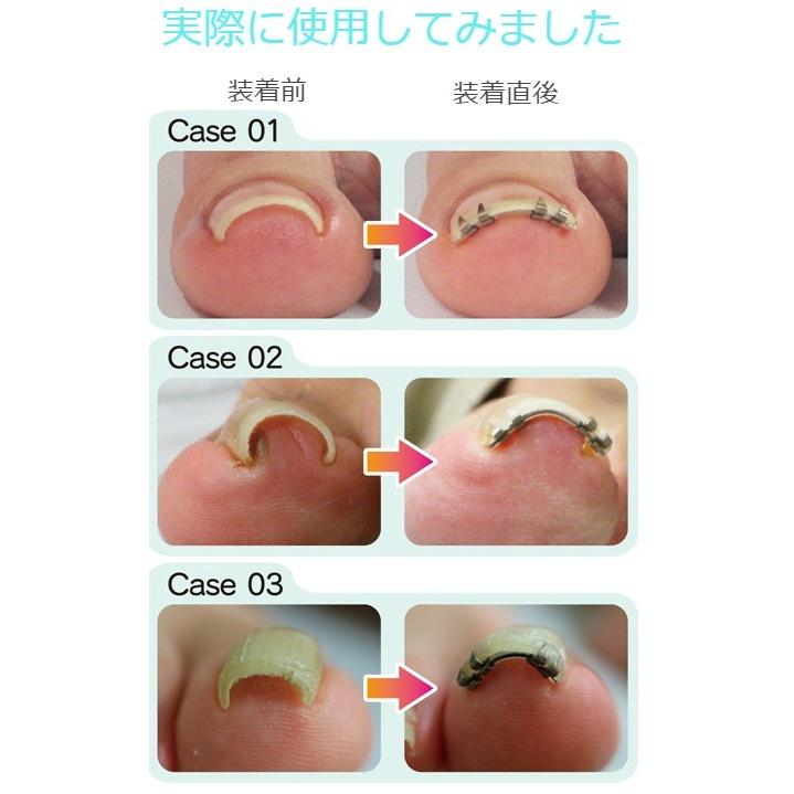 巻き爪リフト 2個セット まきづめ まき爪 弾力性ワイヤーで瞬時に矯正