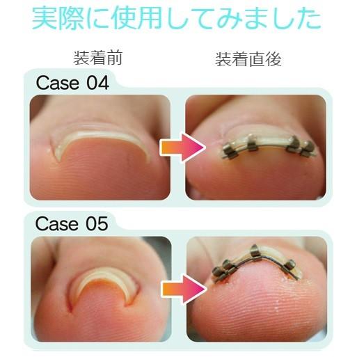 巻き爪リフト 2個セット まきづめ まき爪 弾力性ワイヤーで瞬時