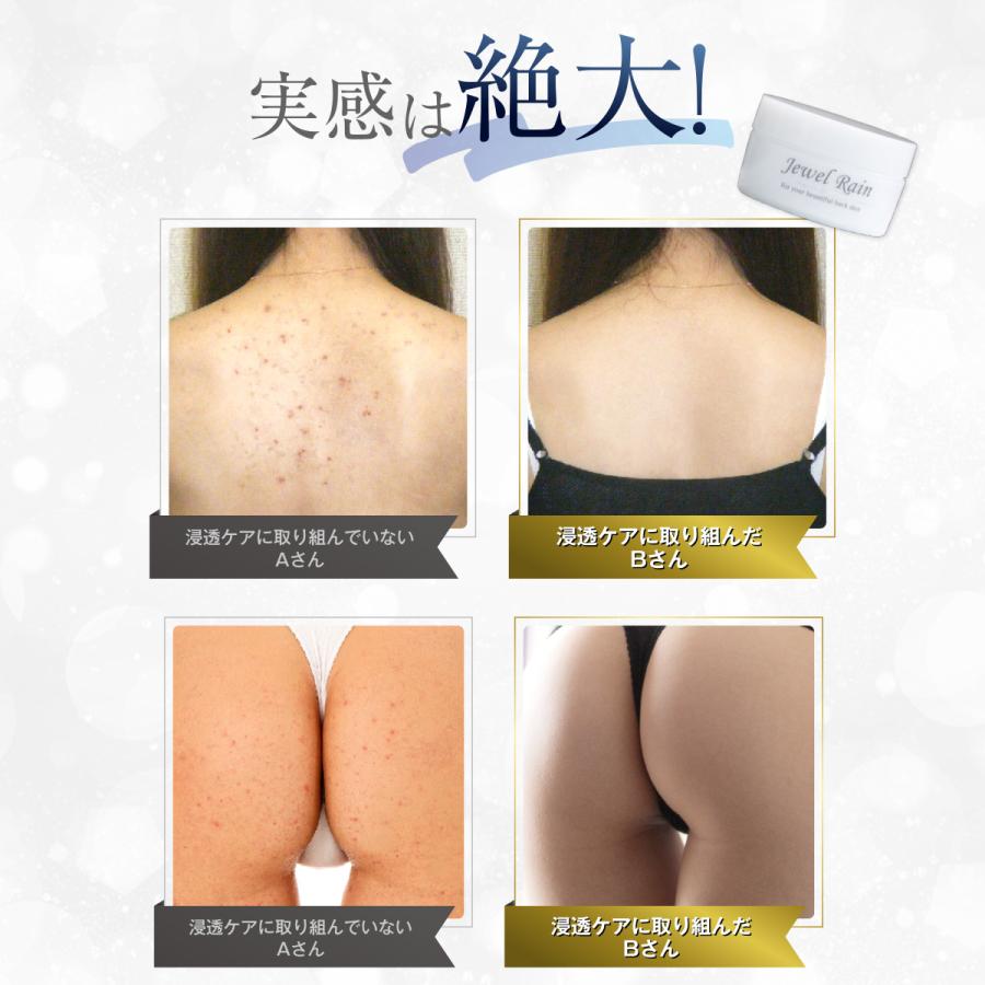 ピカイチ 背中ニキビ ニキビ 保湿 薬用 ボディジェル 公式 ジュエル