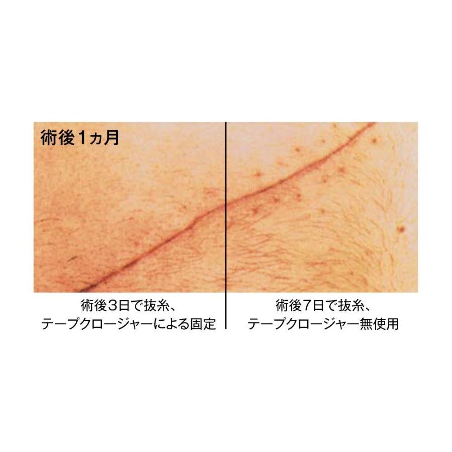 表皮剥離処置 ステリテープ – 表皮剥離 ゲンタシン – YMDE