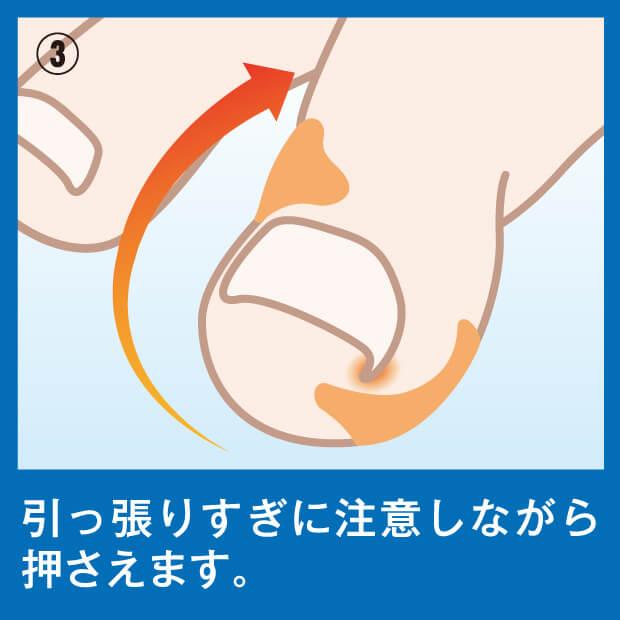 巻き爪テーピングサポートＥＸ 足指の気になる巻き爪部分にテーピングのように巻きつけるだけ 巻き爪 テープ 巻き爪ケアテープ |  | 05