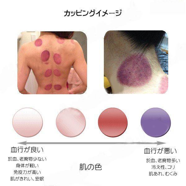 吸い玉 吸玉 6個 セット 肩こり 解消 グッズ 背中 マッサージ 真空ポンプ 於血 汚血 瀉血 東洋医学 血液 血行 美容 健康カッピング 経絡図 つぼ 生活習慣病 :BHG00003:ポケットミートショップ - 通販 - Yahoo!ショッピング 吸い玉 吸玉 6個 セット 肩こり 解消 グッズ 背中 マッサージ 真空ポンプ 於血 汚血 瀉血 東洋医学 血液 血行 美容 健康カッピング 経絡図 つぼ 生活習慣病 :BHG00003:ポケットミートショップ - 通販 - Yahoo!ショッピング