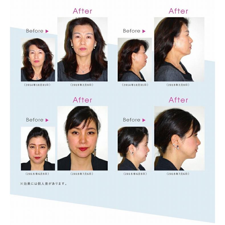 表情筋 口角 小顔 ほうれい線 フェイシャルリフト アトワンスα