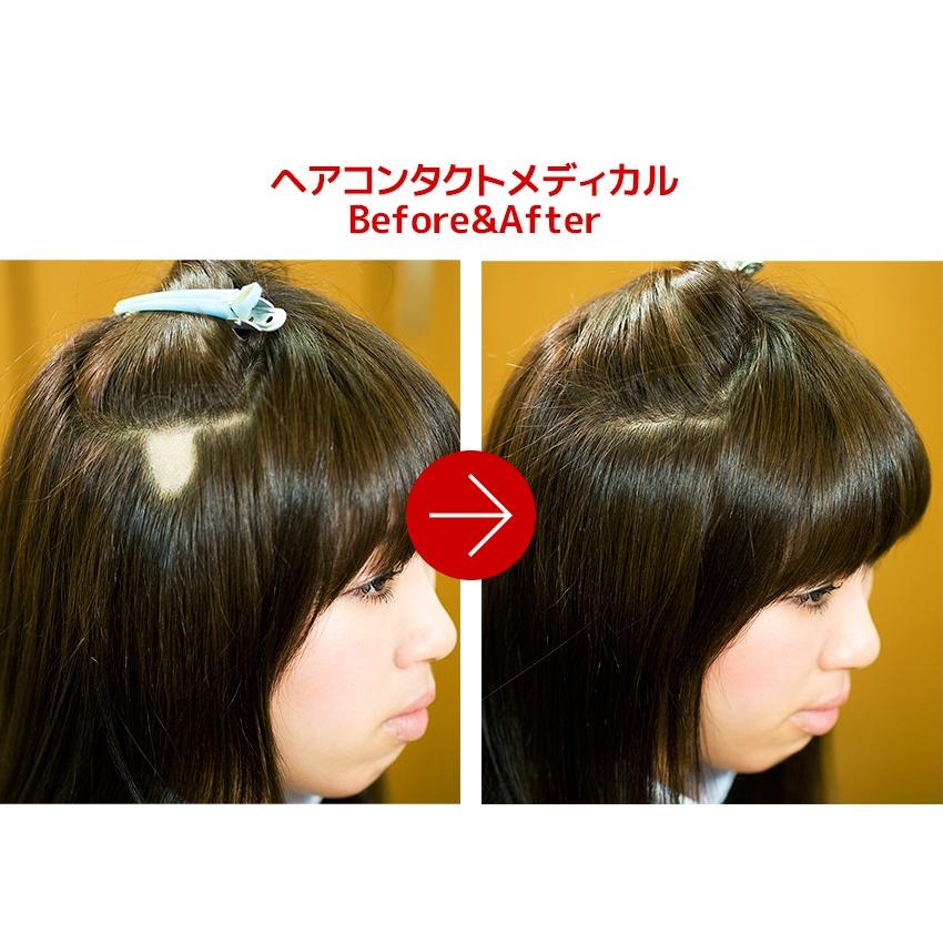 円形脱毛症 隠す 医療用 部分 ウィッグ 自然 男性 女性 プロピア