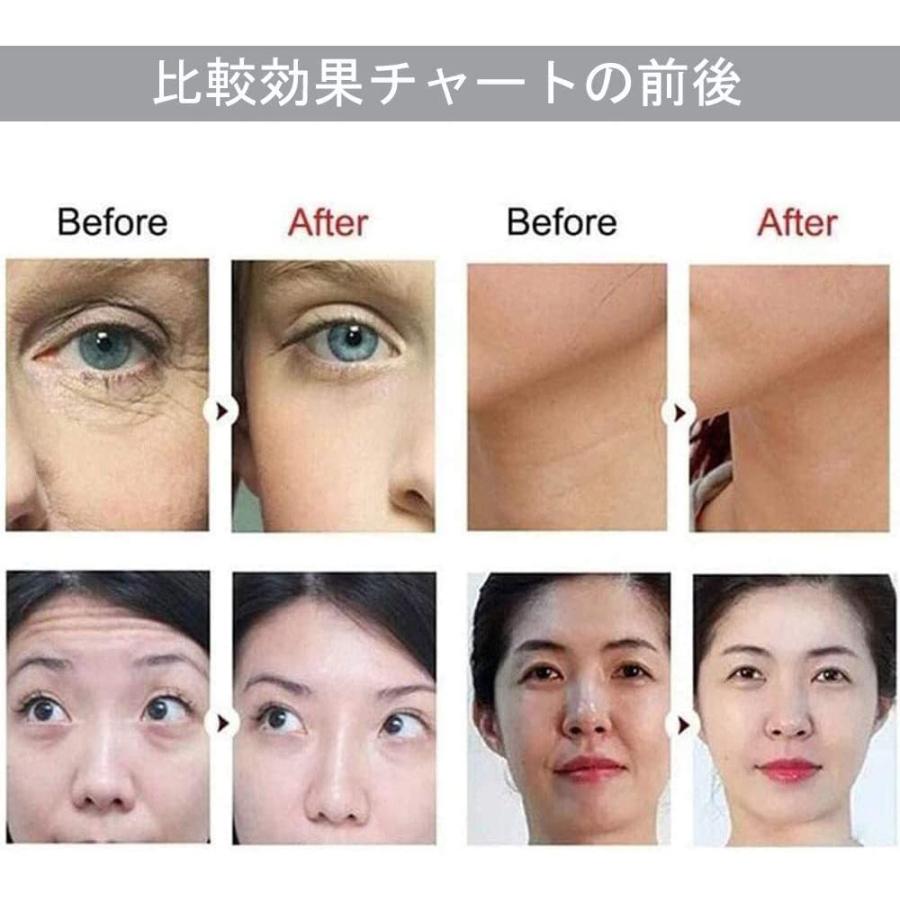 Hifu美顔器 美容機器 家庭用 高密度集点式 ウルトラセル ウルセラ切らない フェイスリフト じわ にきび跡除去 Rfラジオ波 美肌 痩身 多機能 美顔器 Hifu 001a レインボーストア 通販 Yahoo ショッピング