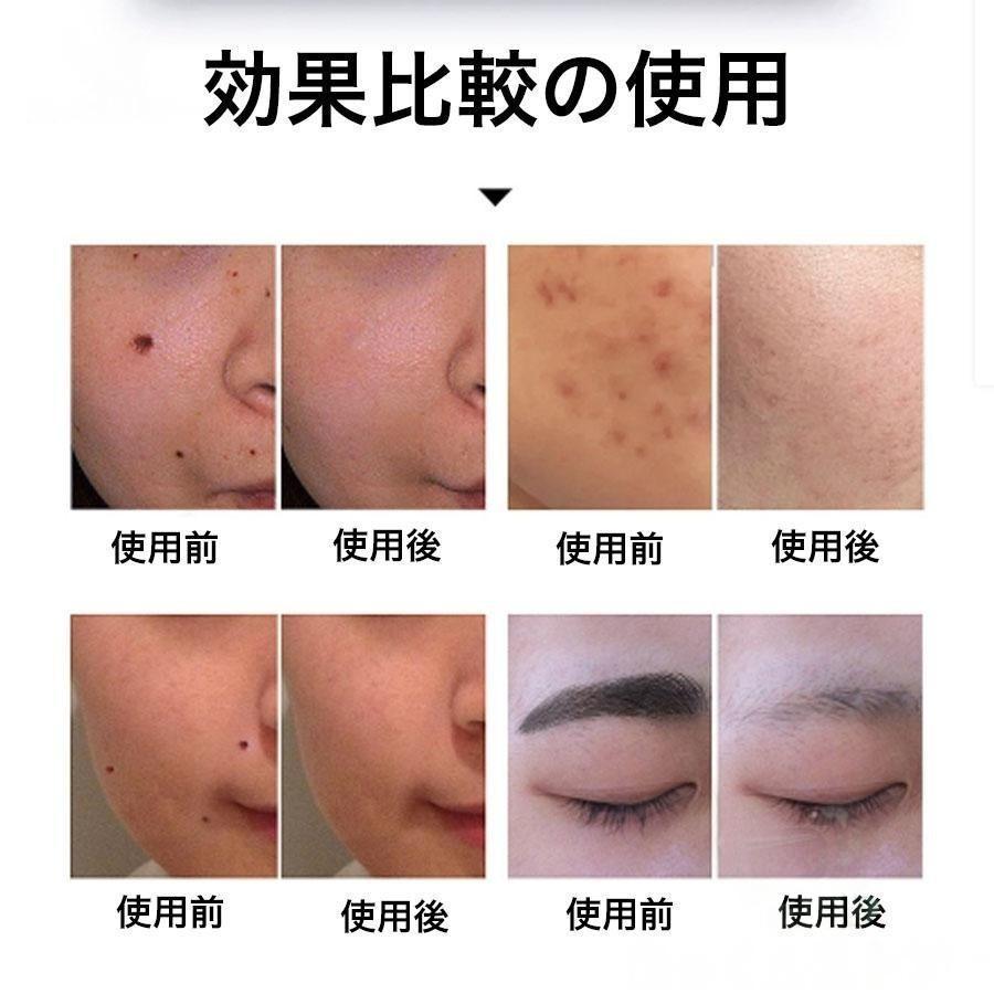 ピコレーザー 美顔器 レーザーペン シミ取り ほくろそばかす除去 シミ