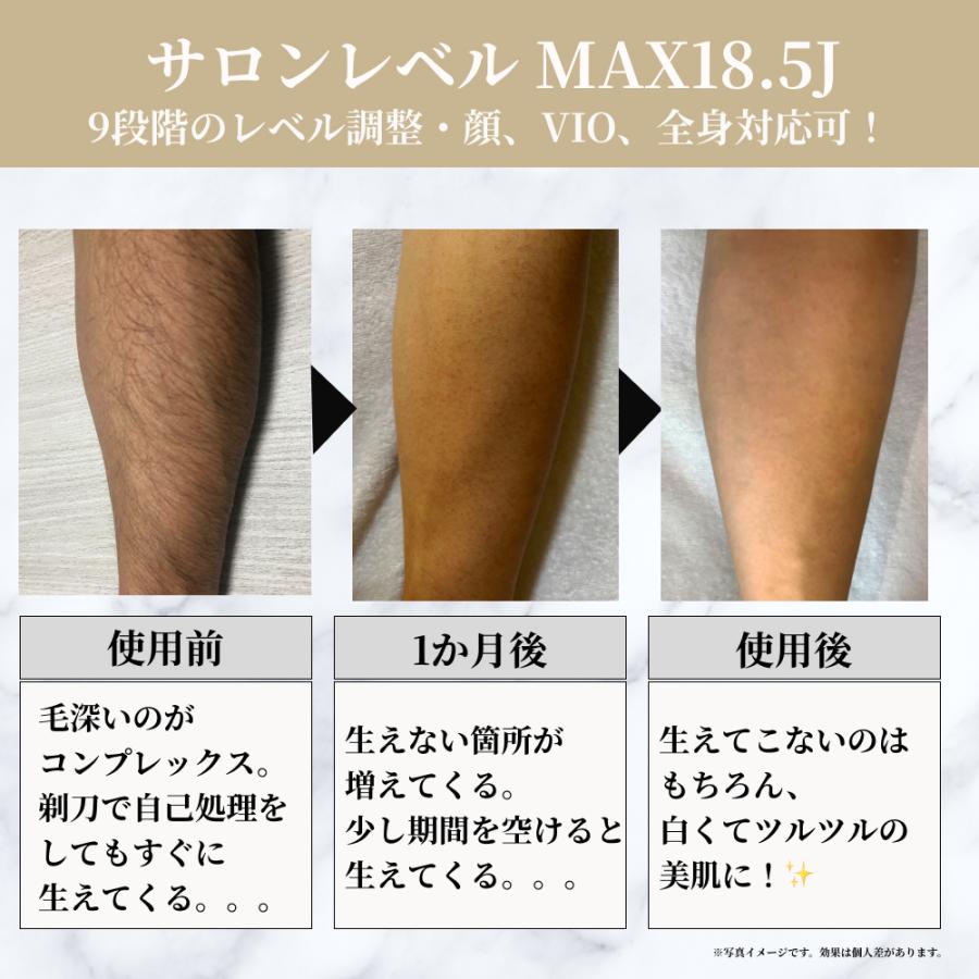 Remozer 脱毛器(新品　未使用) 公式】脱毛器リムーザー Remozer 2 Pro ｜ 2 Pro Self – 【公式