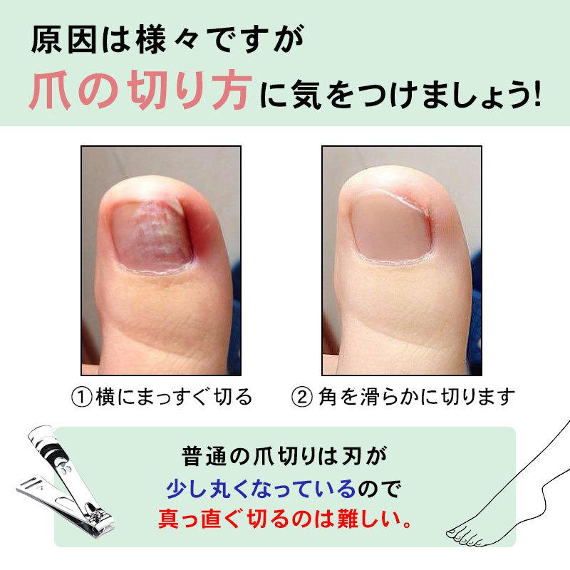 高質で安価 爪切り ニッパー ネイルケア 巻き爪 厚い爪 硬い爪 ゾンデ フットケア つめきり 爪きり 手入れ ツメキリ 切りやすい 握りやすい 手用 足用 高齢者 介護 送料無料 Aynaelda Com