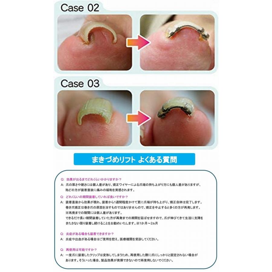 まきづめリフト ヤスリ付 《4本爪、巻き爪 矯正 ワイヤー