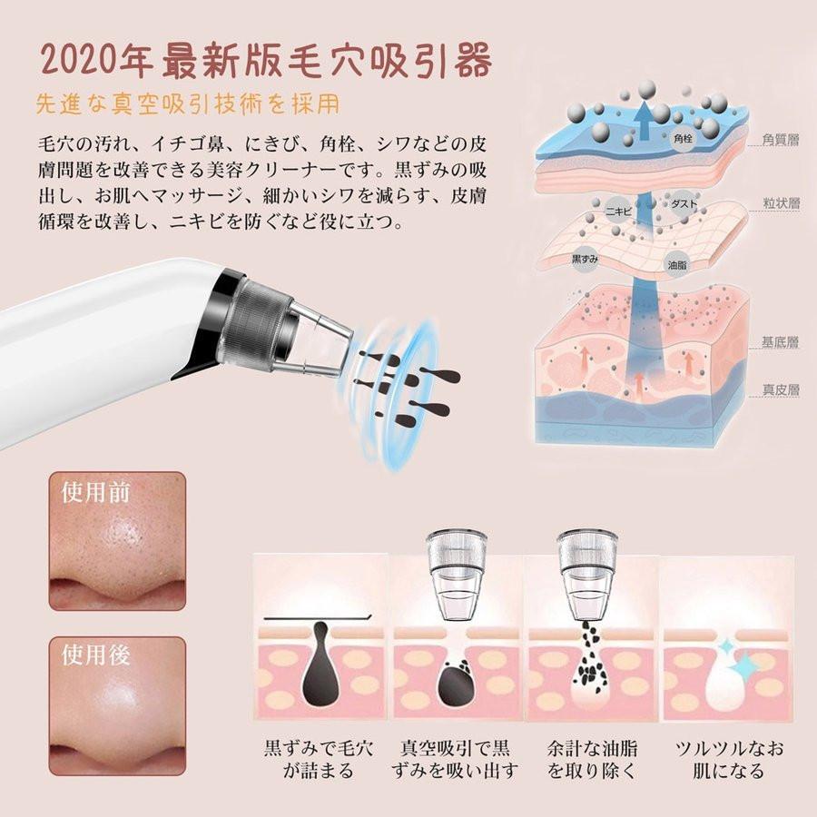 黒 ニキビ 吸引 _ 毛穴吸引器 試してみた – 黒ニキビの原因と治し方・対処法 – UWXOE