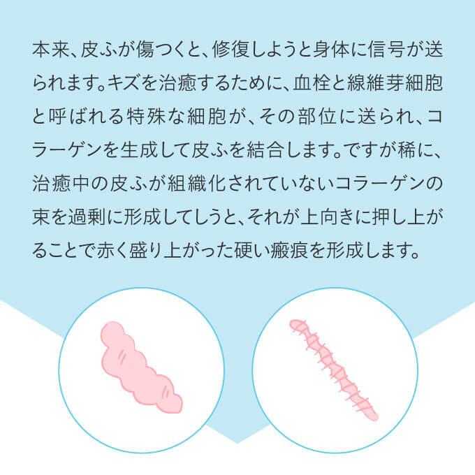 ケロコート 6g 3個セット 国内正規流通品 ニキビ跡 傷跡に 皮膚保護ジェル 傷跡専用 シリコンジェル |  | 04