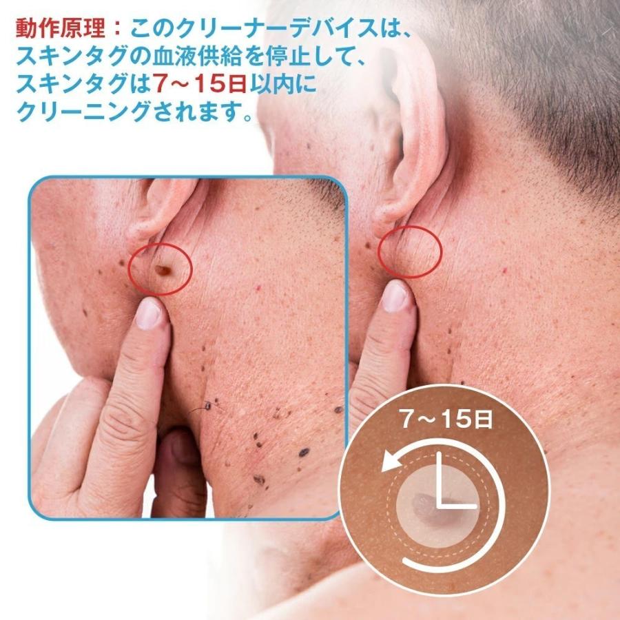 スキンタグリムーバーデバイスキット スキンタグ スキンタグ除去ツールキット ほくろいぼリムーバーパッチ 小型から大型のスキンタグ用 |  | 03