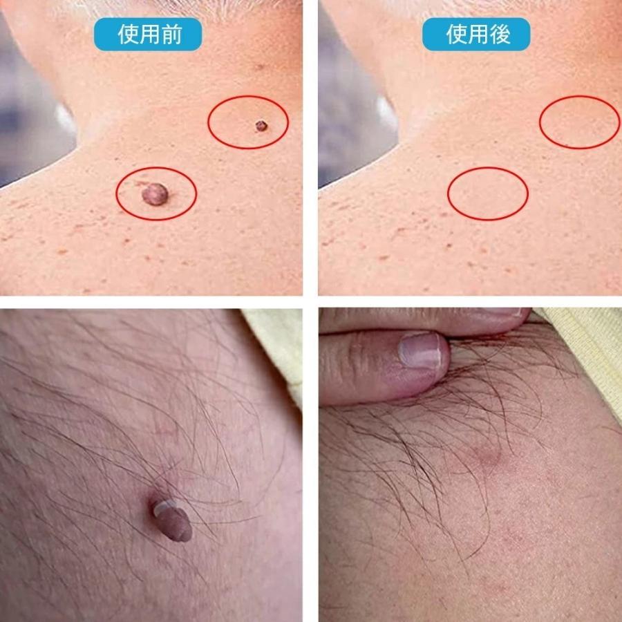 スキンタグリムーバーデバイスキット スキンタグ スキンタグ除去ツールキット ほくろいぼリムーバーパッチ 小型から大型のスキンタグ用 |  | 05