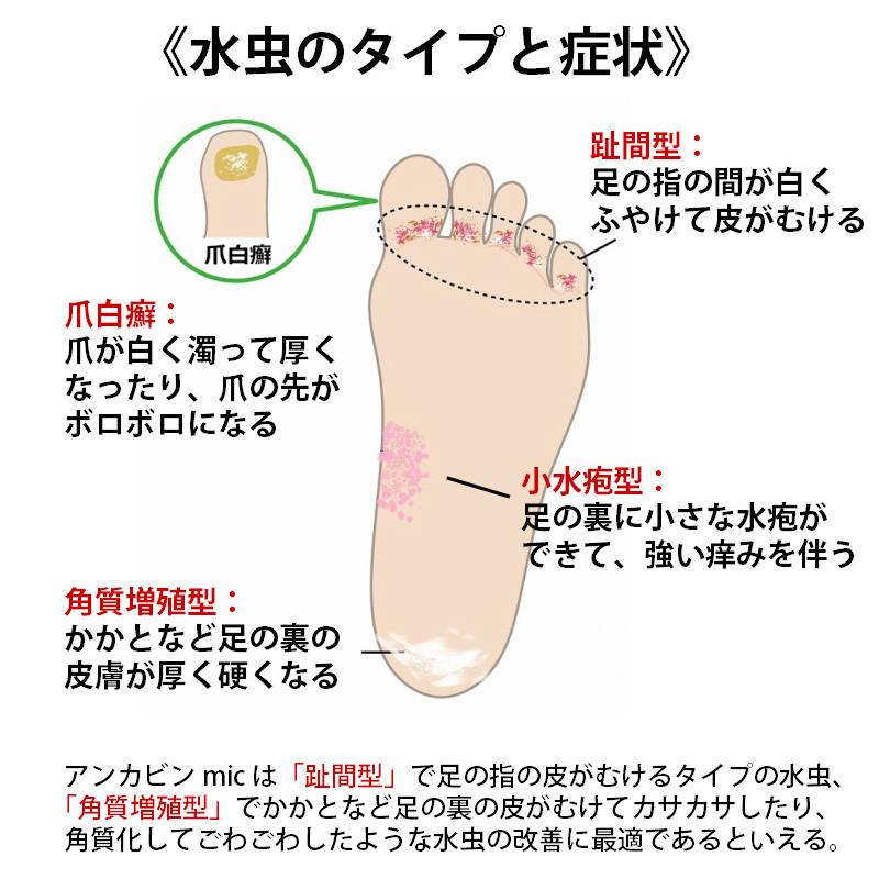 最大44 Offクーポン 爪水虫 水虫 アンカビンmic ml アンカビンミック 白癬菌 ホノミ 第2類医薬品 控 Sarozambia Com