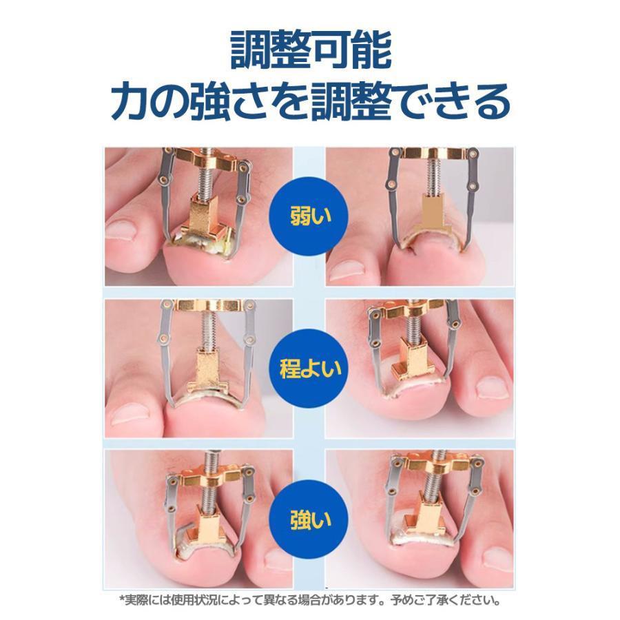 2個セット 巻き爪 矯正 器具 マキちゃんセット 自分で治す方法 巻き爪