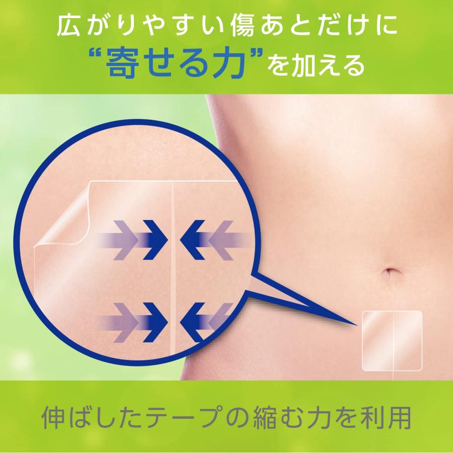 skinix アトレスケア 傷あとケア専用テープ 50×50mm 30枚入 帝王切開