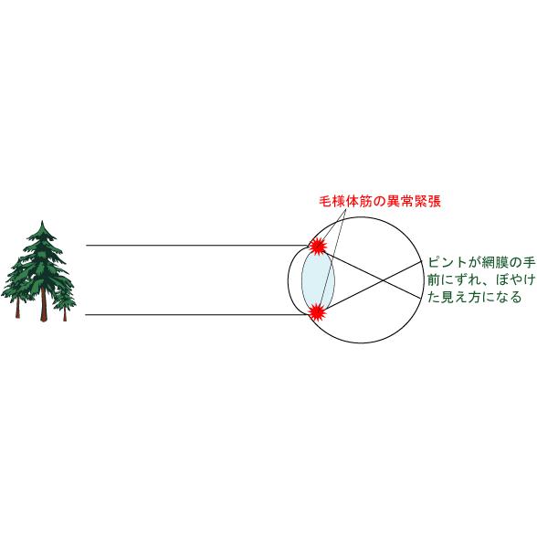 【近視/遠視/弱視/乱視の視力回復】【アングルビジョントレーニング機器+ソニマックセット】｜shiryoku｜04