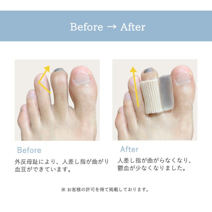 外反母趾対策用品 Sincerus 外反母趾 内反小趾 土踏まず 足指矯正 サポータ グッズ 16種類 柔らか ケア 2個セット 22 人差し指サックと広げシリコン B07kh5x9z1 Sincerus シンケールス 通販 Yahoo ショッピング
