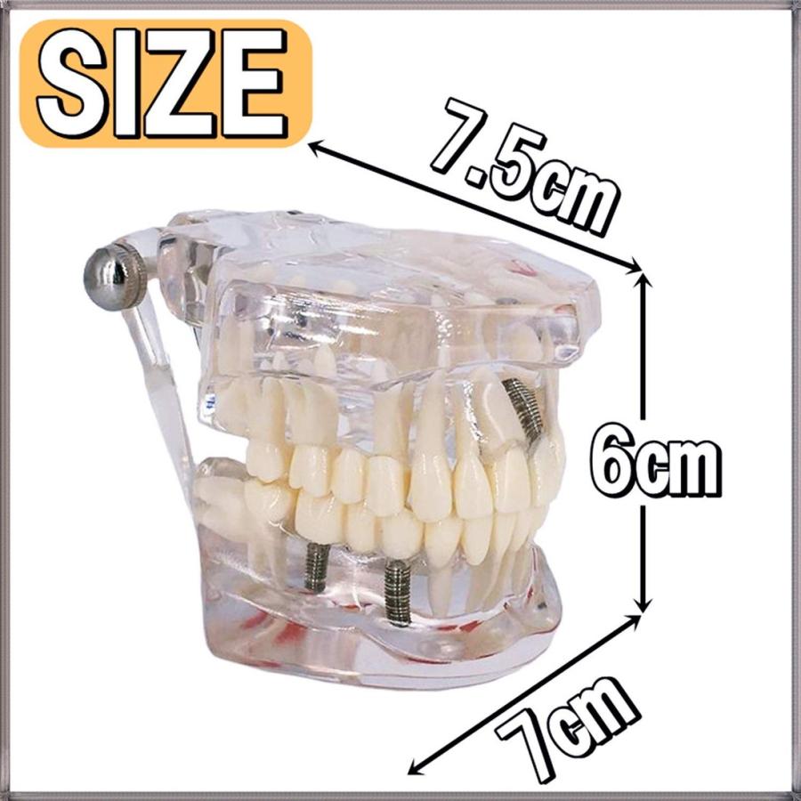 歯科模型 歯列模型 実物大・透明 インプラント ブリッジ 差し歯 歯医者