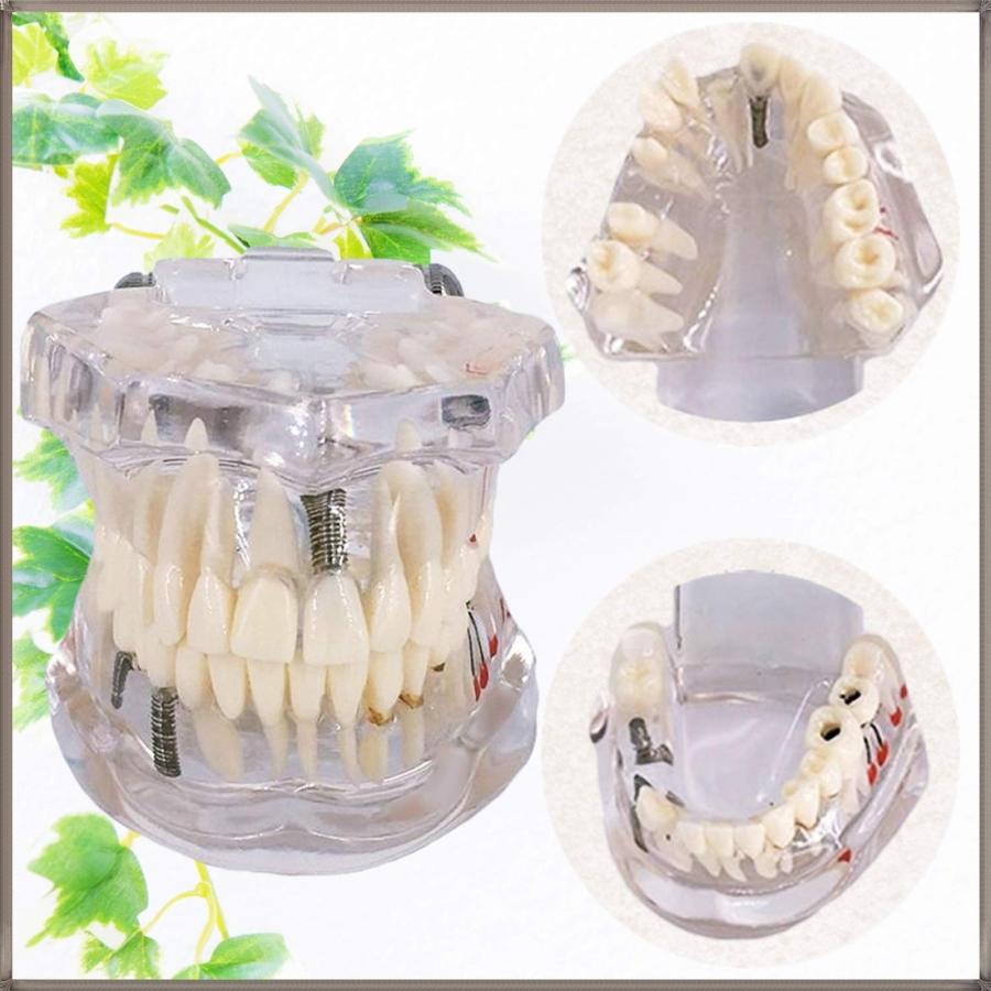 歯科模型 歯列模型 実物大・透明 インプラント ブリッジ 差し歯 歯医者