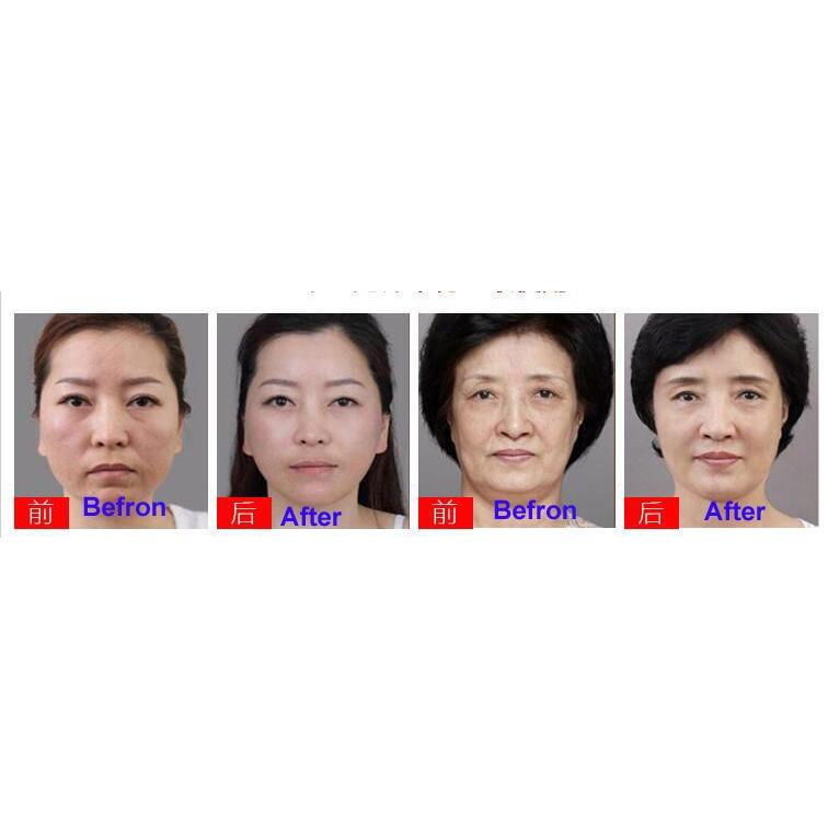 Rf 無線 周波数 顔 サーマ クール スキン 若返り しわ 除去 肌の引き締め フェイスケア マシン 領収発行可 涼風市場 通販 Yahoo ショッピング