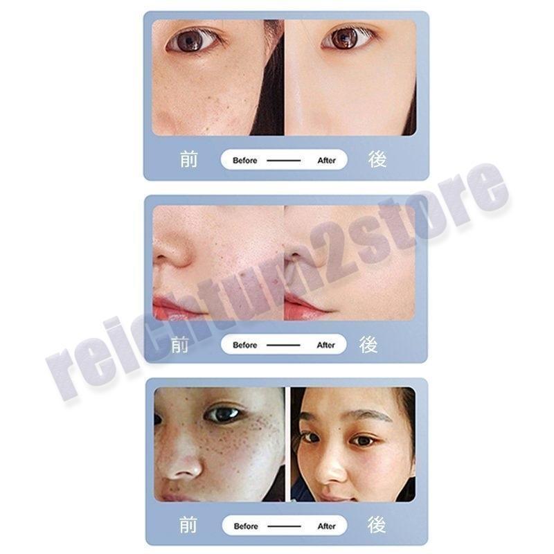 美顔器 ピコレーザー 美顔器 ほくろそばかす除去 美顔器