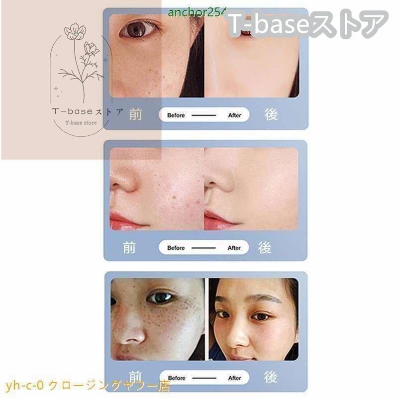 美顔器 ピコレーザー 美顔器 ほくろそばかす除去 シミ 斑 青色レーザー 赤色レーザー 美容機器 レーザー そばかす 毛穴 シワ 傷跡 ピコ秒レーザー 美顔器 そばかす 毛穴 シワ