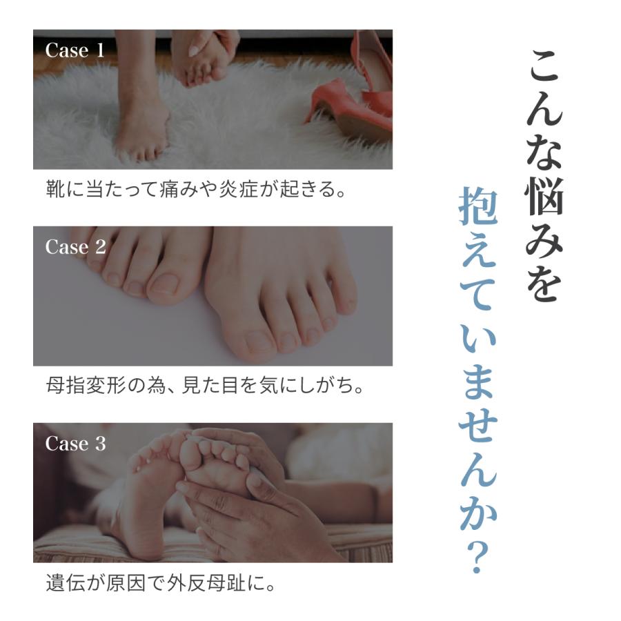 2個入 外反母趾サポーター 外反母趾 グッズ Tech Love 足指サポーター 靴 日本製 シリコン 矯正 親指 対策用品 オーバープロネーション 足の形 歩き方 22 Kl001aj 2 Techlove Onlineshop 通販 Yahoo ショッピング