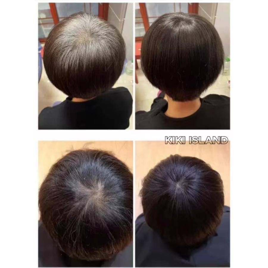 人毛100％ 部分ウィッグ 自然 高品質 15cm 医療用 ボブ ヘアピース