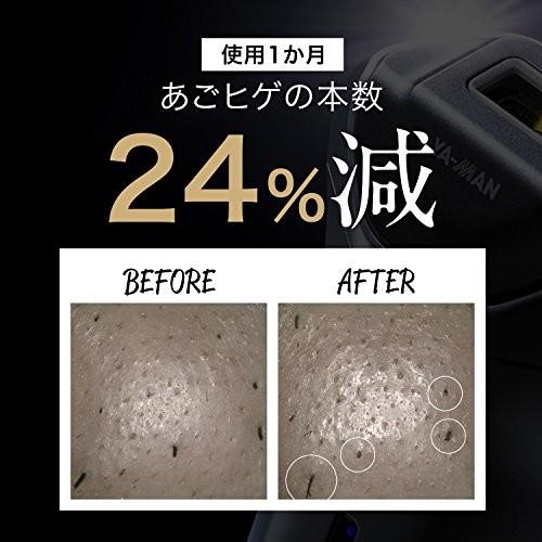 YA-MAN(ヤーマン) 家庭用 脱毛器 メンズ レイボーテ EX STA-200B 商品情報