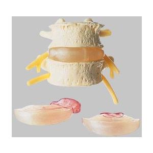 ヘルニア模型 Qs68 3 ソムソ Somso 053 0029 001 テーピング 鍼 灸 トワテック 通販 Yahoo ショッピング