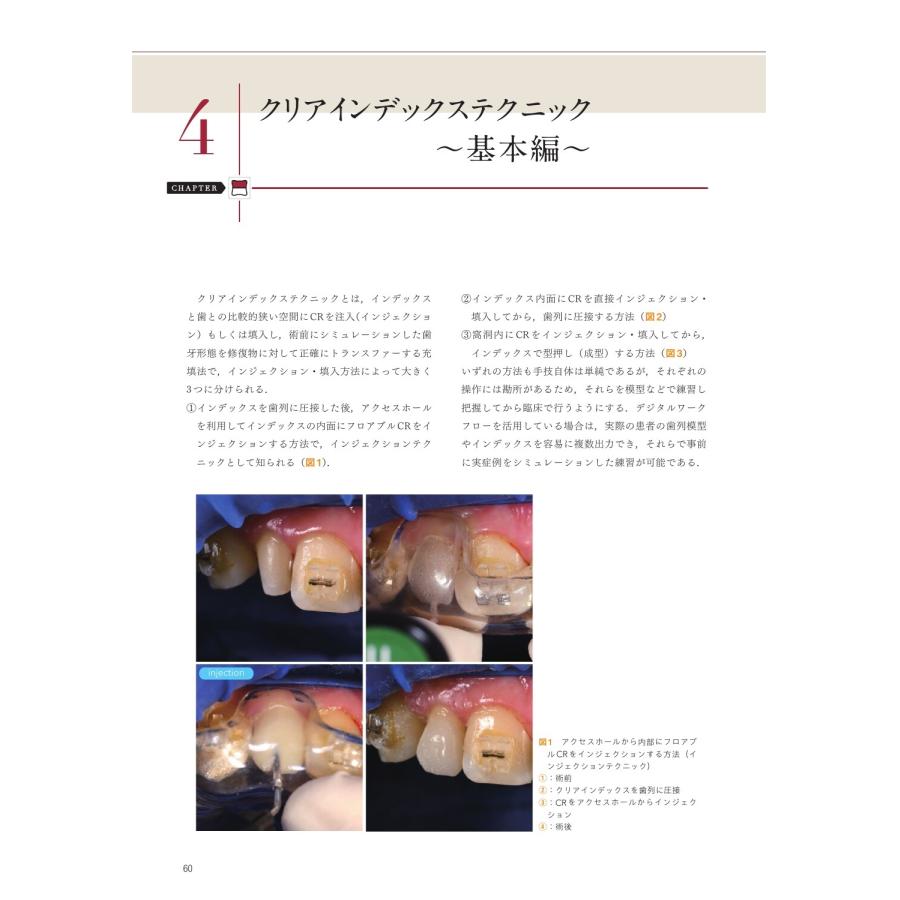 保坂啓一 CR修復が速く確実・きれいに行える クリアインデックス