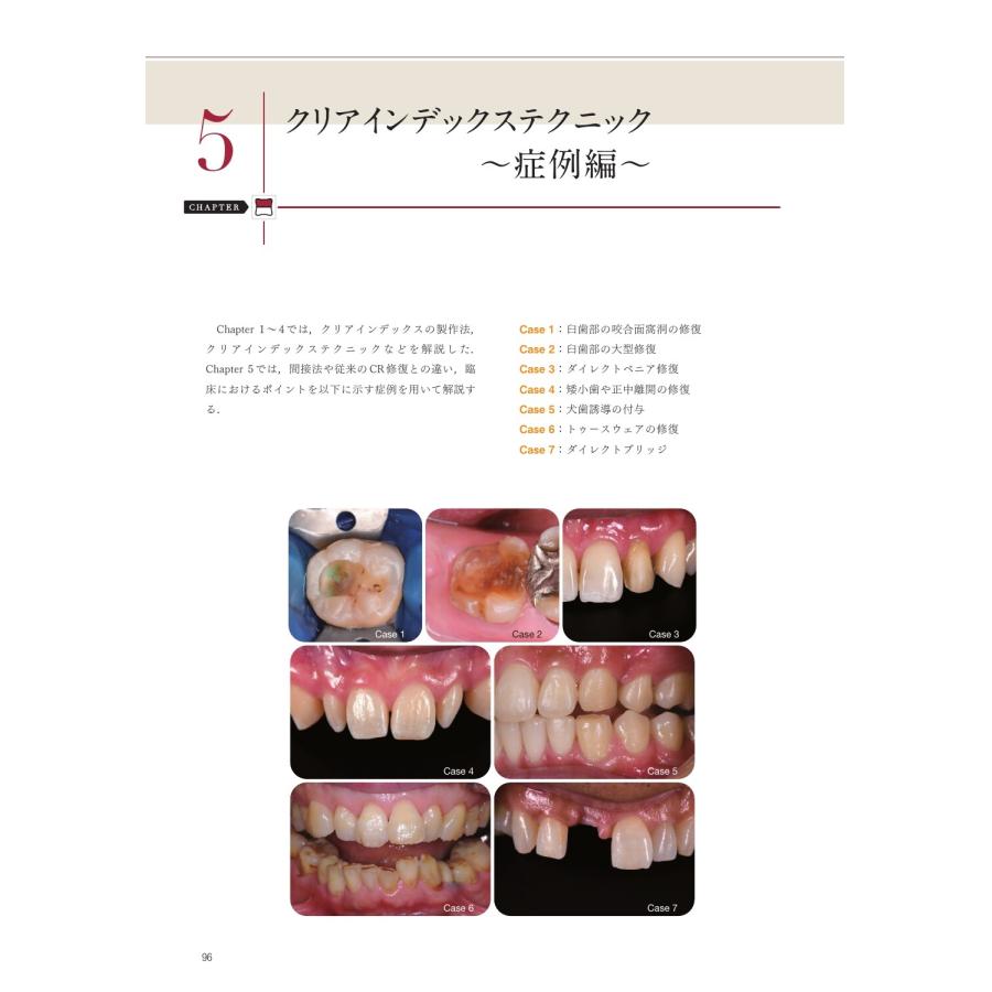 保坂啓一 CR修復が速く確実・きれいに行える クリアインデックス