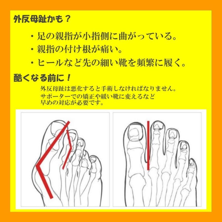 外反母趾サポーター 医療用 左右セット 外反母趾 足指矯正 広げるシリコンセット 親指 痛い 悪化防止 ベルト 治す 保護 Kgs0001 トレードワンジャパン 通販 Yahoo ショッピング
