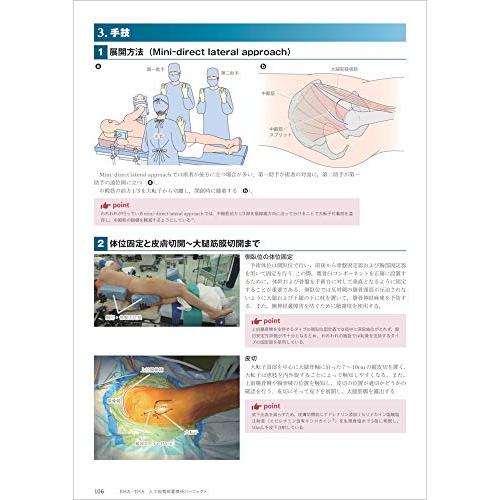 BHA・THA 人工股関節置換術パーフェクト?人工骨頭置換術・人工股関節全置換術の基本とコツ BHA THA 手術までの準備 術前計画