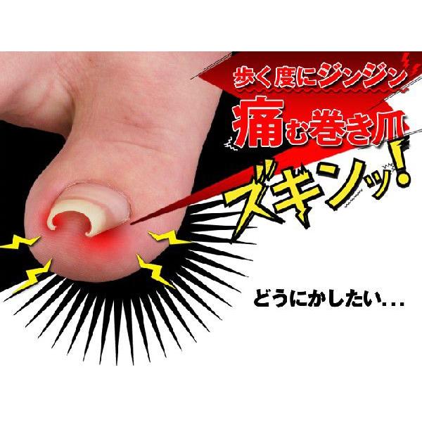 巻き爪 巻爪 ワイヤーガード 治療 矯正 治し方 自分で 一般医療機器 リフト ブロック テープ 矯正器具 1箱 1ヶ月分 日本製