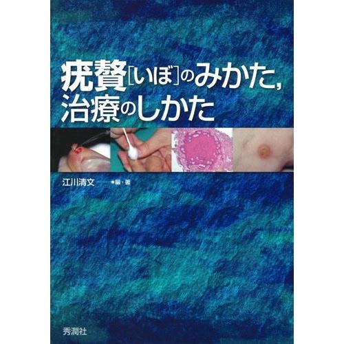 疣贅（いぼ）のみかた、治療のしかた 疣贅(いぼ)のみかた、治療のしかた : 有隣堂ヤフーショッピング店
