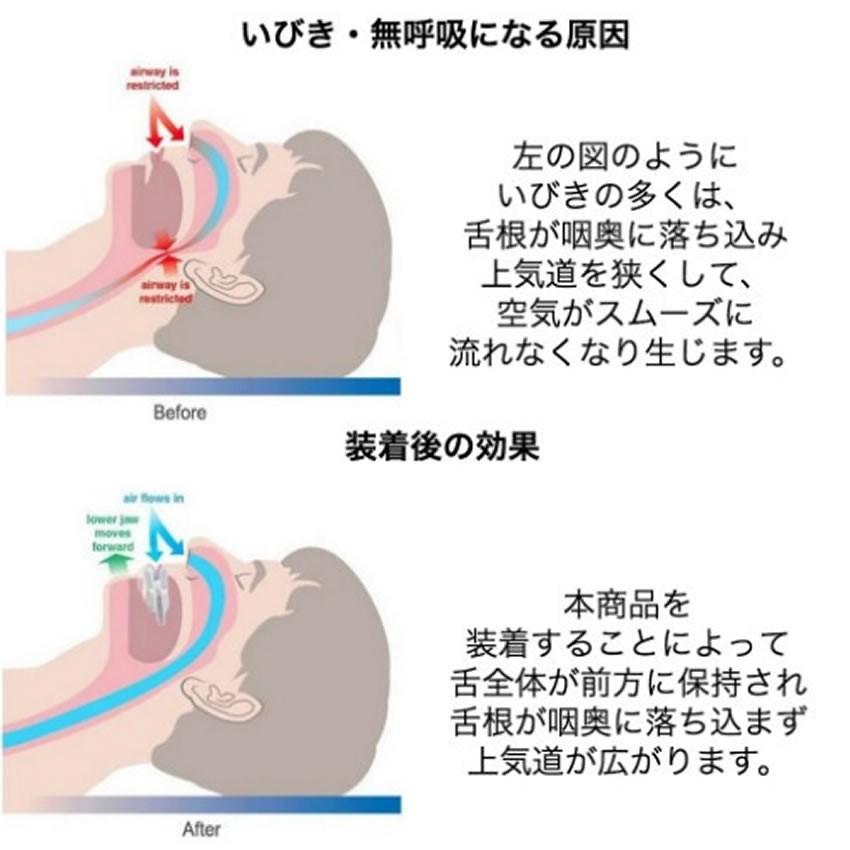 舌用 マウスピース 舌 口呼吸 いびき いびき防止 グッズ 小型 軽量 旅行 安眠グッズ 快眠 不眠 寝具 熟睡tecc-sitapeace|zakkayacom|03